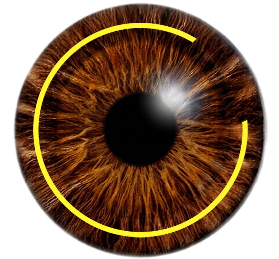 일반라식 절개 비교