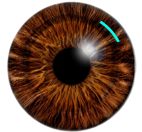 스마트노바프로 절개 비교